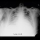 Pumonary edema, pneumonia: X-ray - Plain radiograph